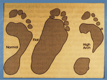 Different Foot Types